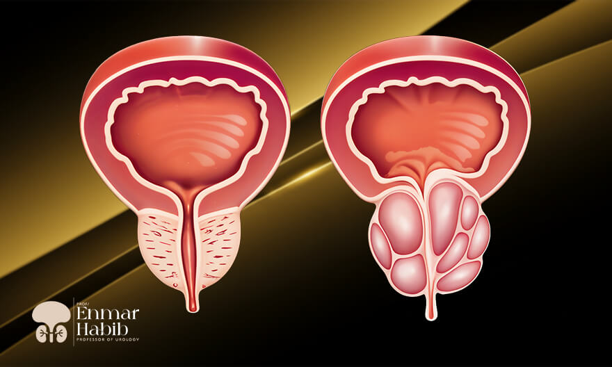 BPH-treatment-without-surgery BPH-treatment-without-surgery