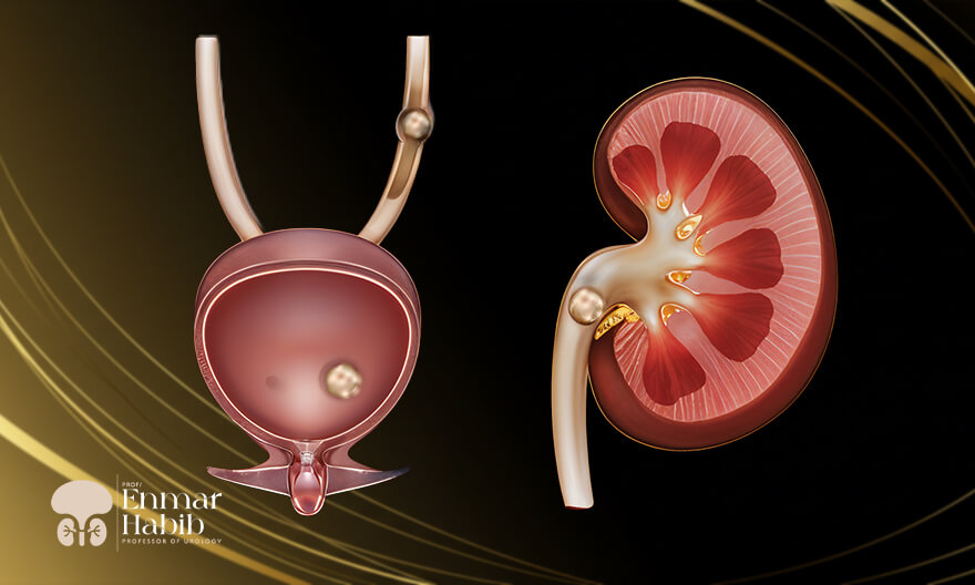 Treatment-for-Urinary-Tract-Stones-in-Adults-Without-Surgery Treatment-for-Urinary-Tract-Stones-in-Adults-Without-Surgery