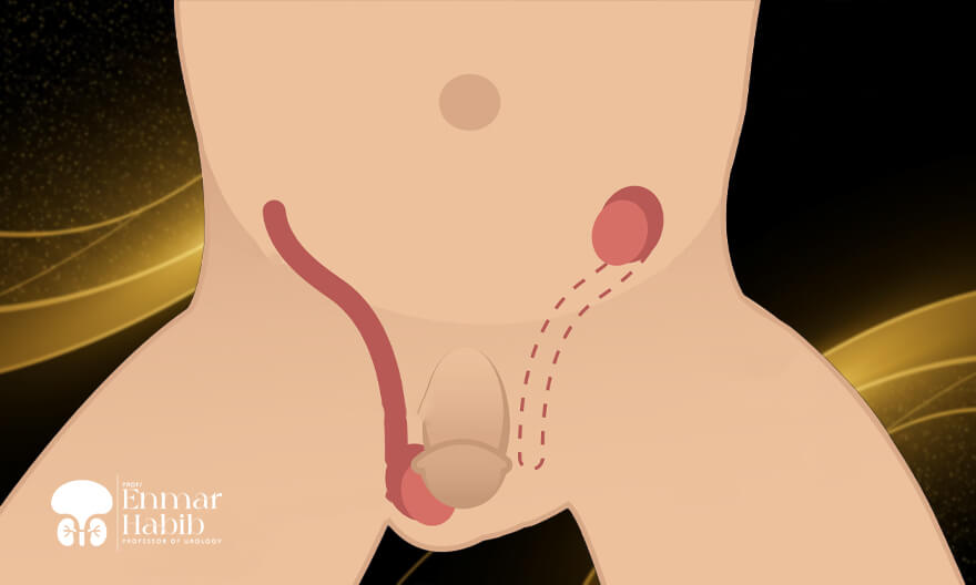 Treatment-of-Undescended-Testicle-and-Retractile-Testicle